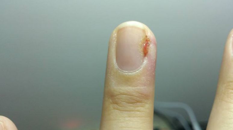 撕"倒戗刺"可能会导致截指,你信吗?|男子拇指扎根小刺差点丢了手指