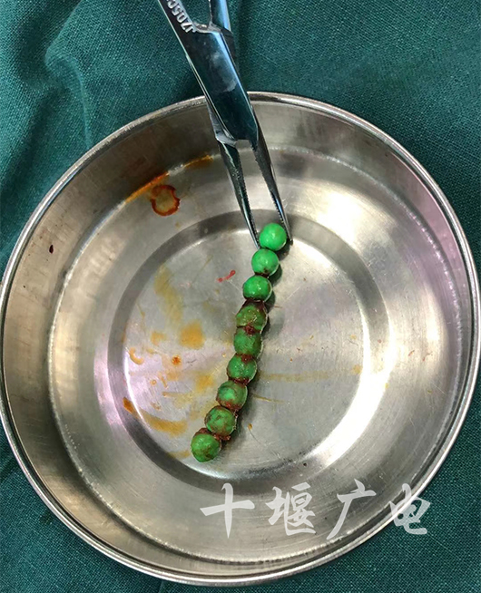 和大肠串起来了,患者的大小肠出现了移位,已经堵死肠道流通了一段时间