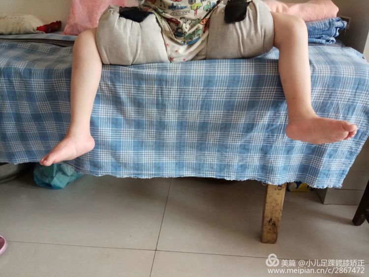 先天性髋关节脱位治疗方法首选保守治疗疗程一般一年左右费用也不高