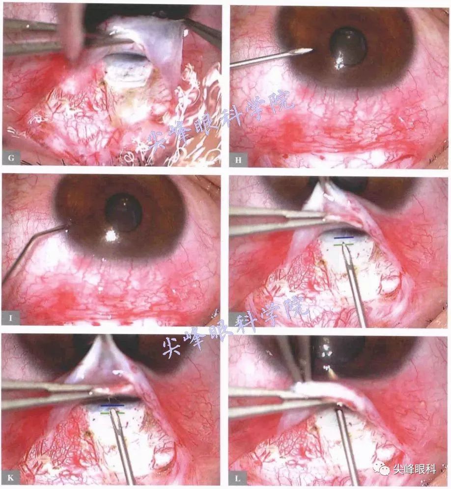 express青光眼微型引流器植入手术part02图解青光眼手术操作与技巧043
