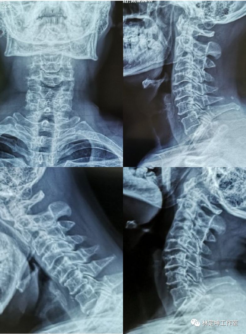 不正常的颈椎x光片图图片