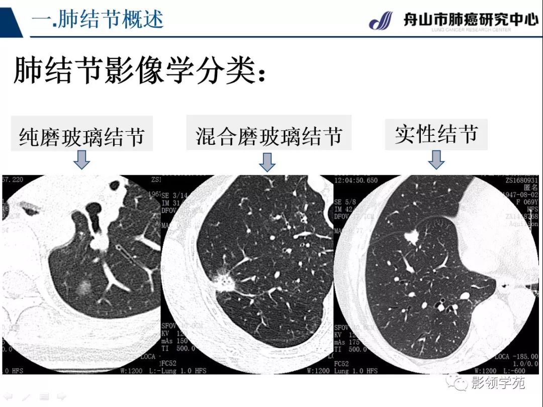 肺良恶性结节ct征象及鉴别诊断