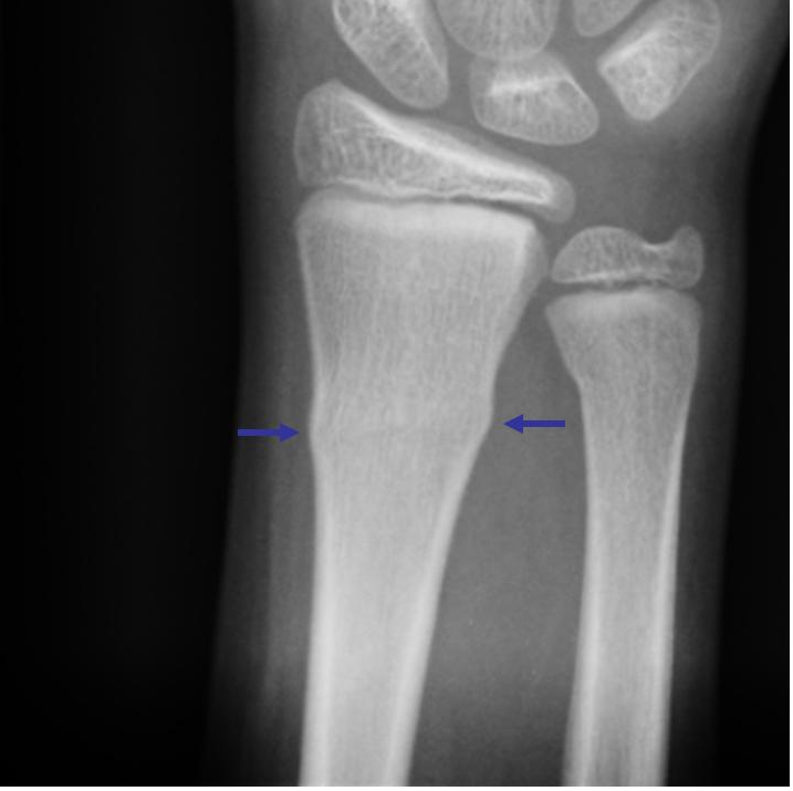 儿童青枝骨折图片图片