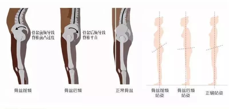 骨盆后倾图片对比图片