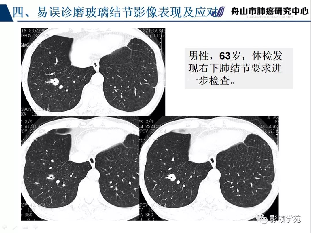 肺良恶性结节ct征象及鉴别诊断