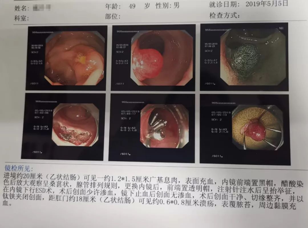 直肠息肉山田二型图片