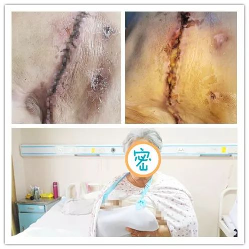 没想到10天前无意中发现的乳腺肿物术中病理竟是乳腺癌不管有没有乳腺