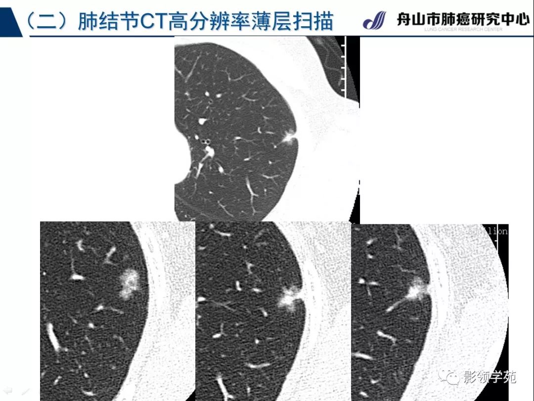 充分顯示結節內部的細微結構(肺小葉氣道,血管及小葉間隔,肺間質及