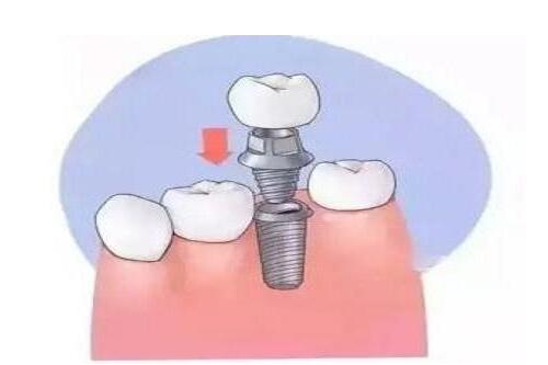 人工种植牙一颗价格是多少|合肥