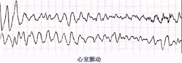 无脉性室速典型心电图图片