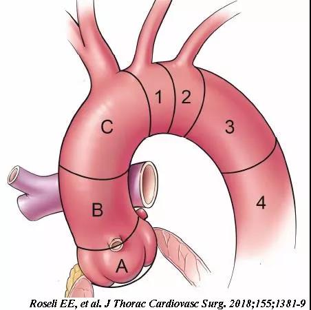 來自四川大學華西醫院心臟大血管外科的胡佳副教授就對於累及升主動脈