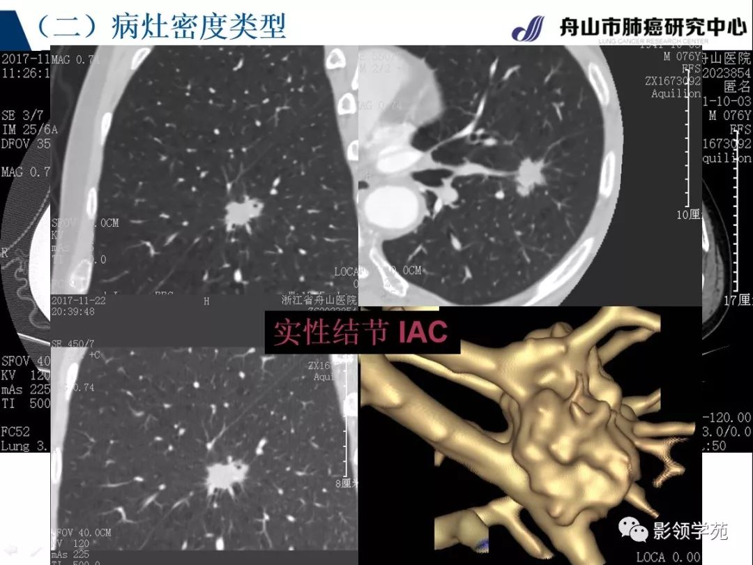 肺良恶性结节ct征象及鉴别诊断
