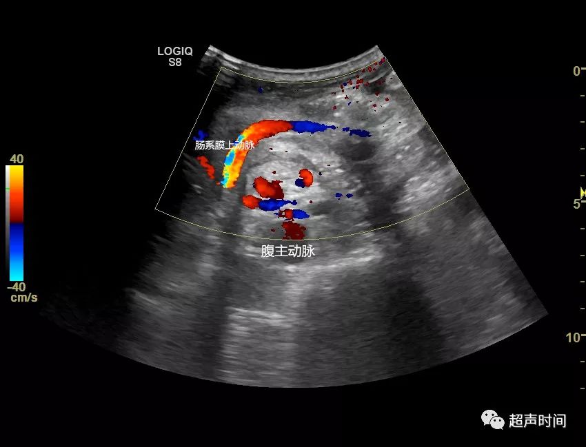 「漩涡征」:超声诊断小肠扭转的线索_肠系膜