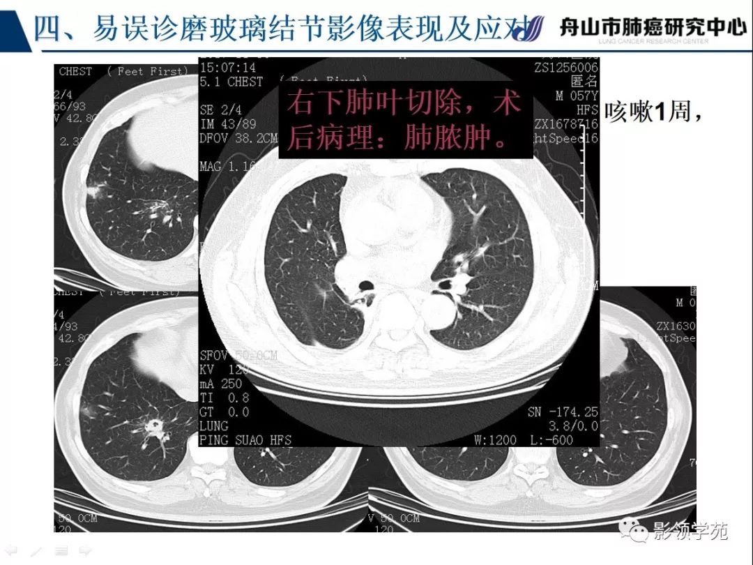 肺良恶性结节ct征象及鉴别诊断