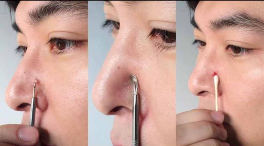 鼻头挤出来的白丝是什么男生别不懂快来看看吧