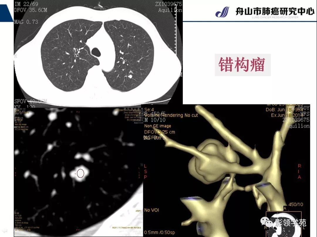 肺良惡性結節ct徵象及鑑別診斷