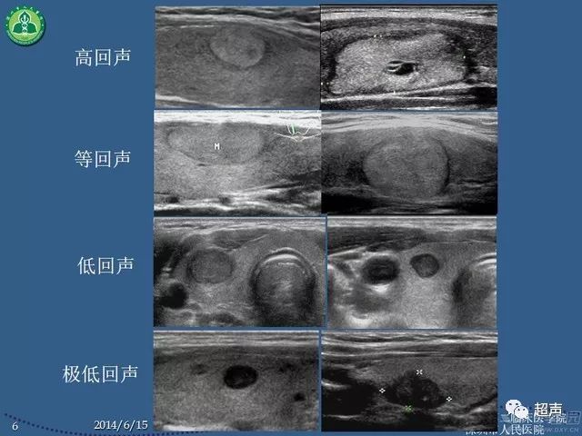 超声微课堂甲状腺癌的早期超声诊断及新进展