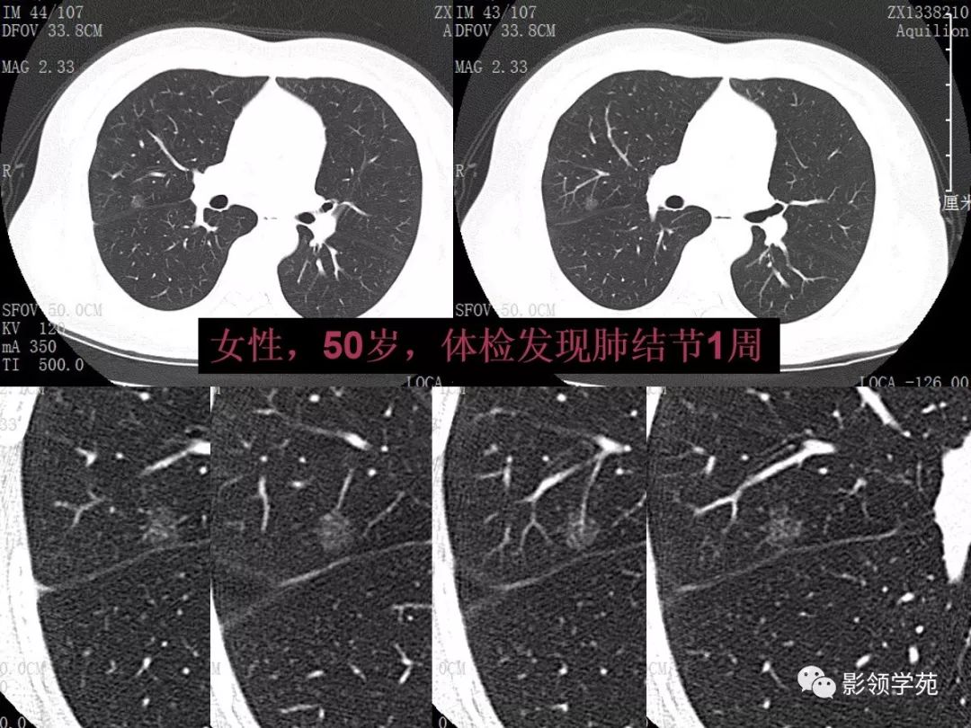 肺良惡性結節ct徵象及鑑別診斷