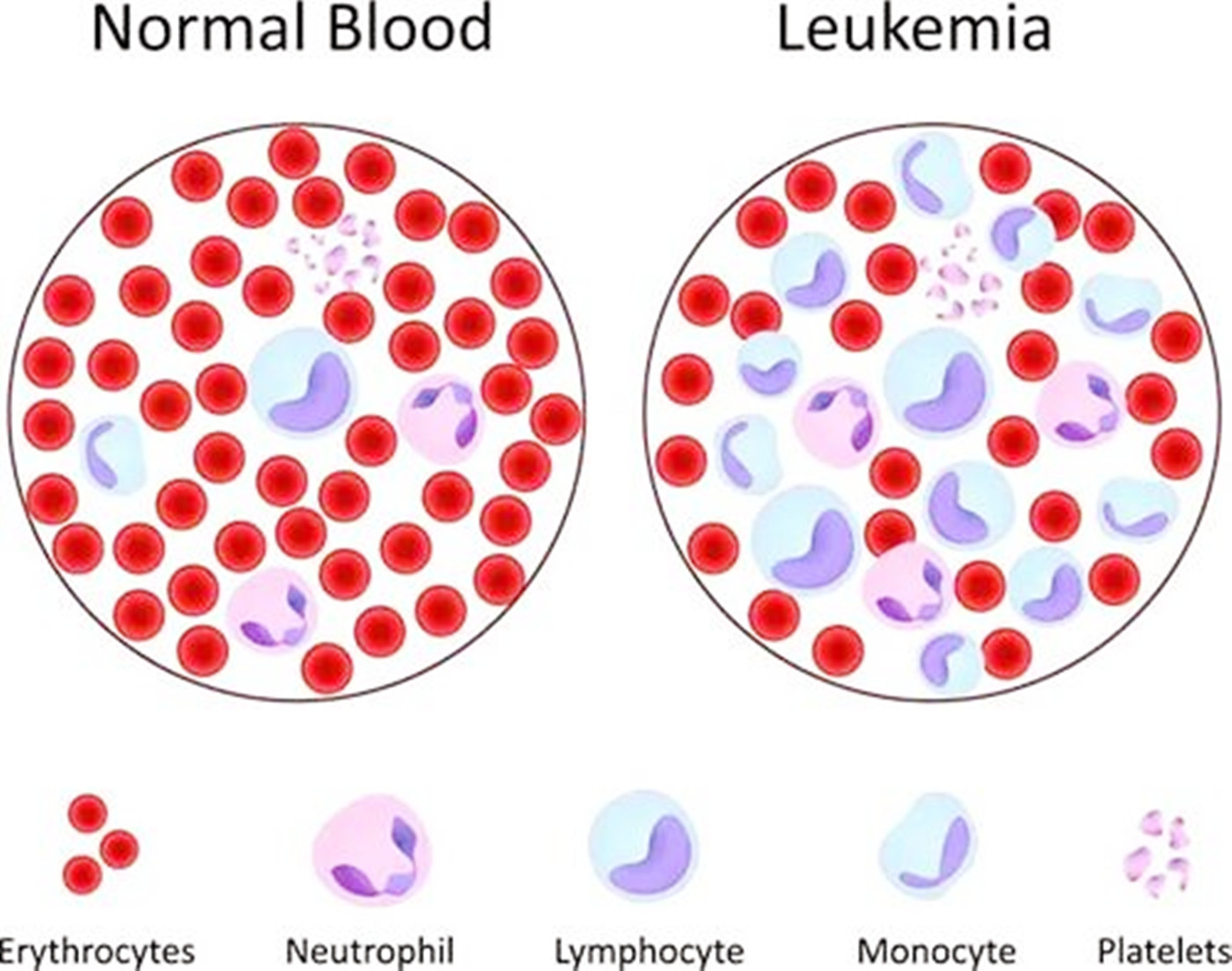 原创白血病为何总找孩子风险性元凶要提前预防看你家有吗