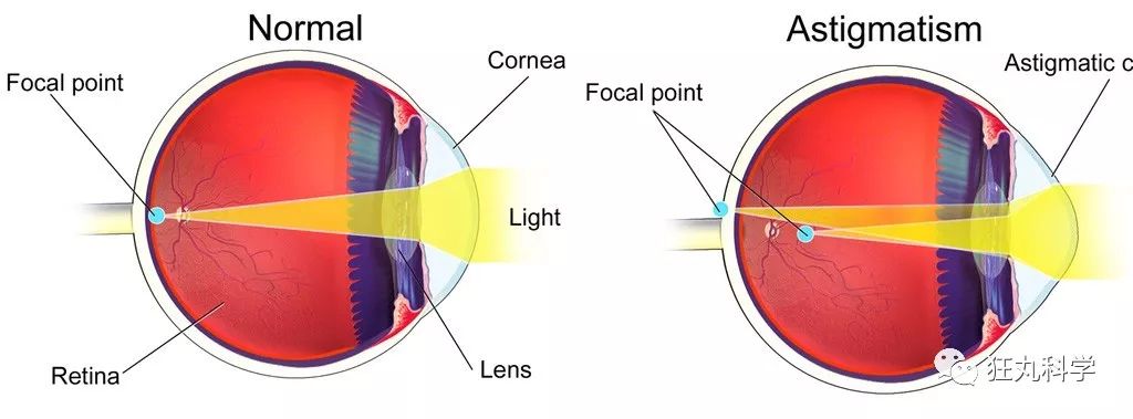 左:正常 右:散光因此即使通过镜片矫正了视力,但如果继续保留散光的话