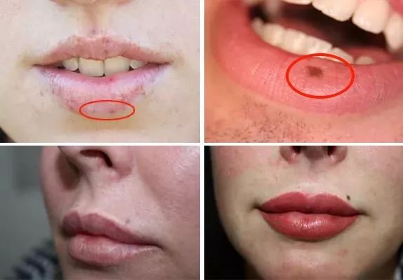 而且不仅仅是变干变丑,更可怕的是会晒出唇斑!