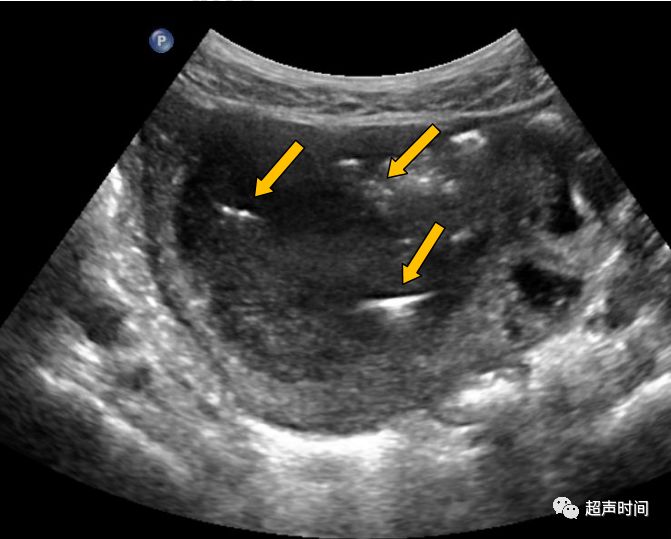 胃腸超聲疑難病例16下腹部腫塊