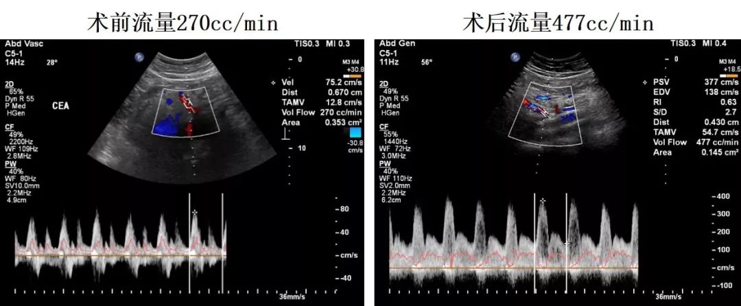 首创全程腔内修复治疗a型主动脉夹层远端破口