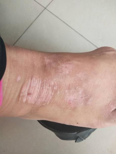 小火针,大治疗——万荣县人民医院皮肤科