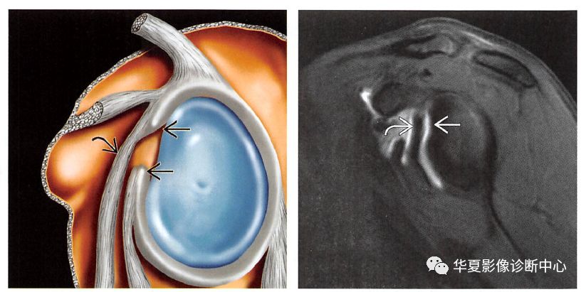 肩关节盂唇损伤,工作中常常遇到 但是有些是正常的变异 不要误诊了