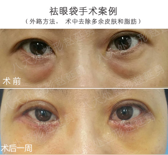 眼角越大眼睛越好看吗?这些误区必须要看_手术