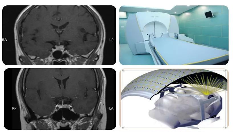 伽马刀就是利用射线照射垂体瘤达到治疗目的,其副作用较低,每组射线