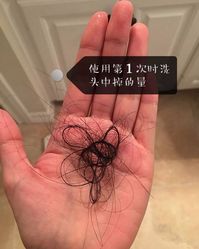 脱发掉发头发稀少这个方法30内让你发量增加一倍