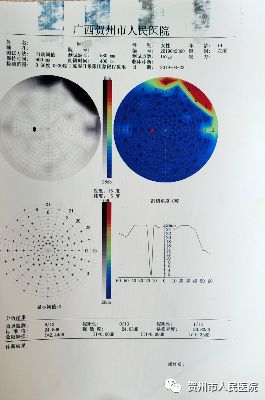 视野缺损是什么感觉图片