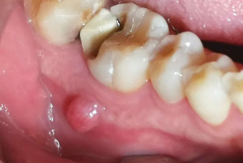牙根尖周脓肿图片图片