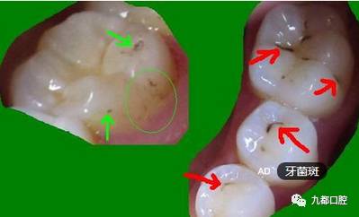 蛀牙的表现症状请大家自我对比