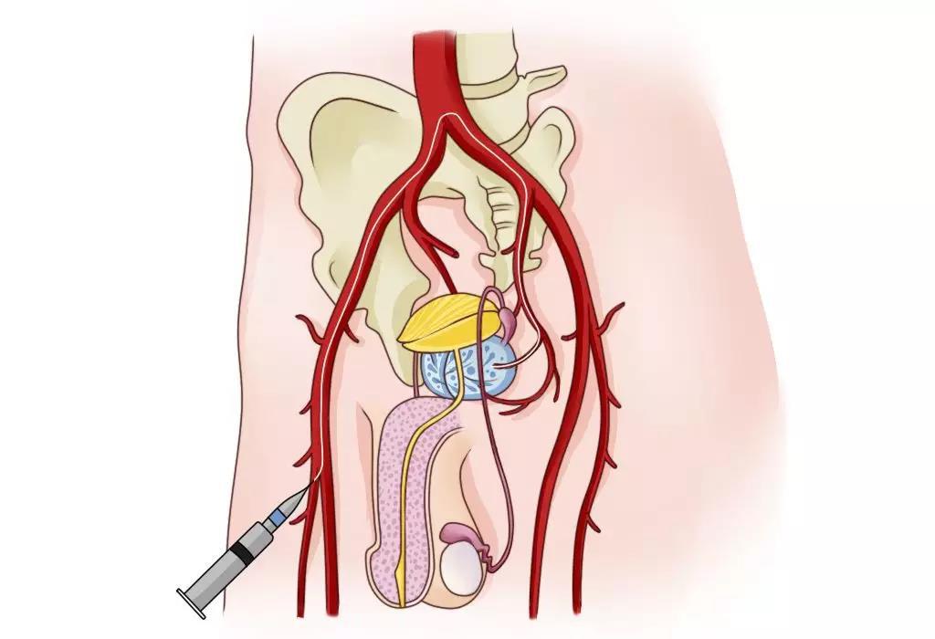 前列腺动脉解剖图图片