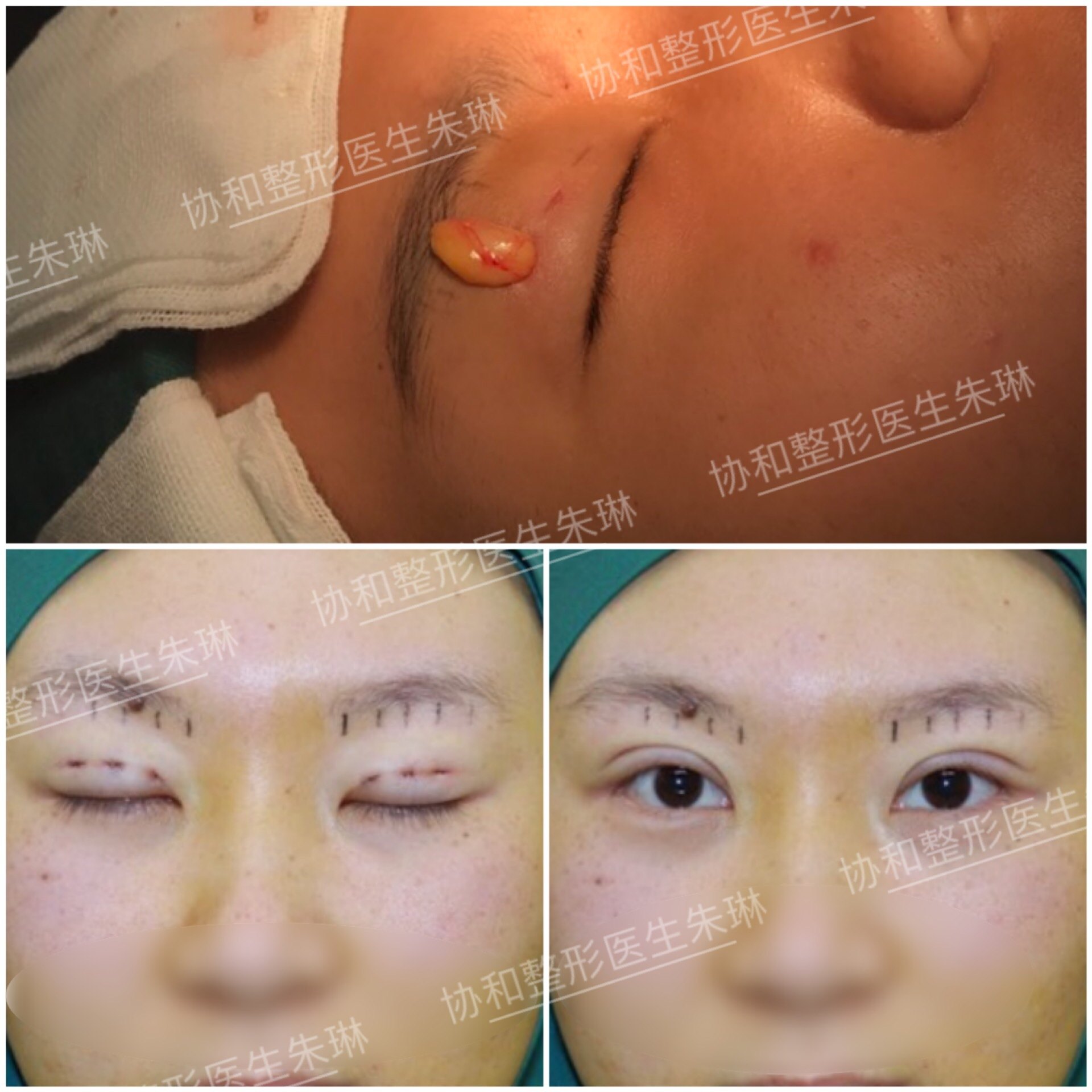 微创小切口双眼皮案例no.1905091 (原创)