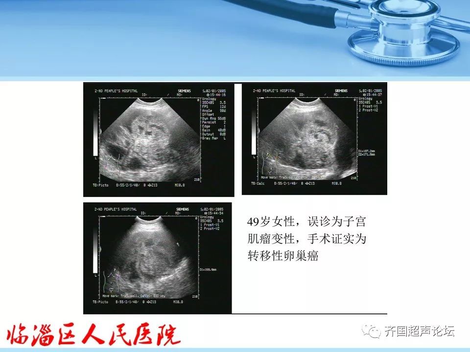 临医超声学堂卵巢肿瘤超声诊断