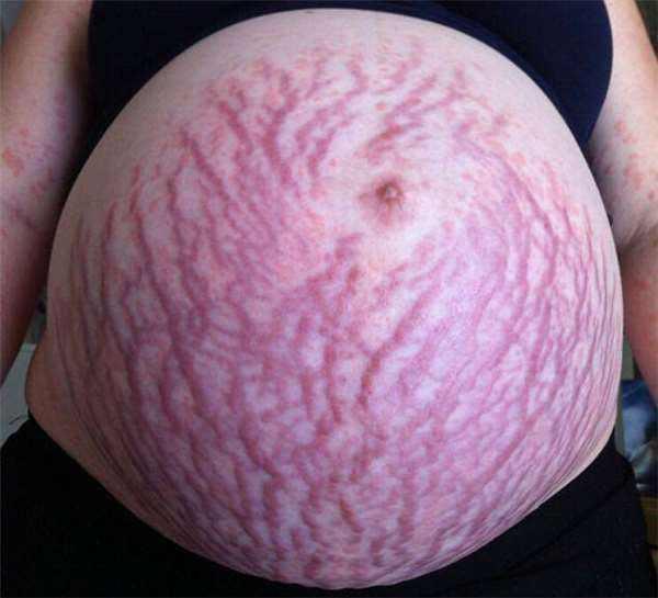 生完孩子的肚子妊娠纹图片