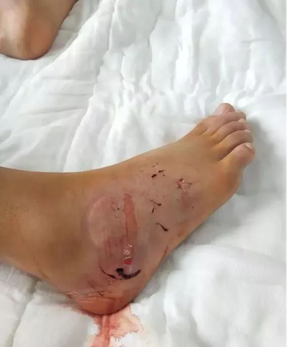 注意长沙小伙湘江边清晨被剧毒蛇咬伤进了icu