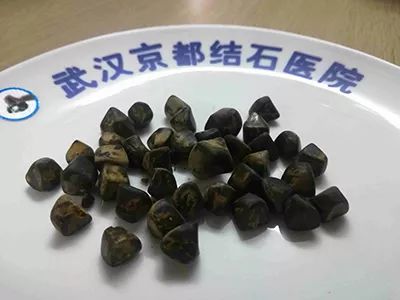 孕妇为什么患胆结石的风险更高?