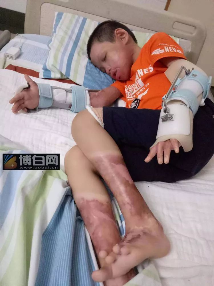 父亲去世母亲残疾博白10岁小男孩被煤气烧伤不愿出门见人