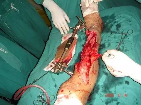 ③.泌尿科前列腺电切术的病人.