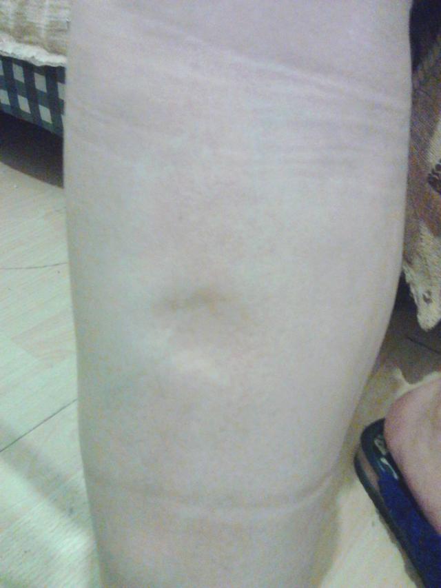 37岁男子查出尿毒症烟酒不近提醒这2件事做太多了