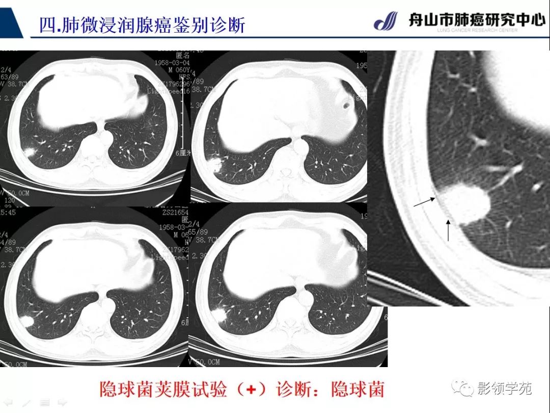 经典微浸润肺腺癌