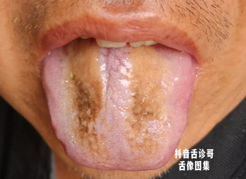 抖音舌诊哥舌诊知健康教你学会看舌象系列三十九