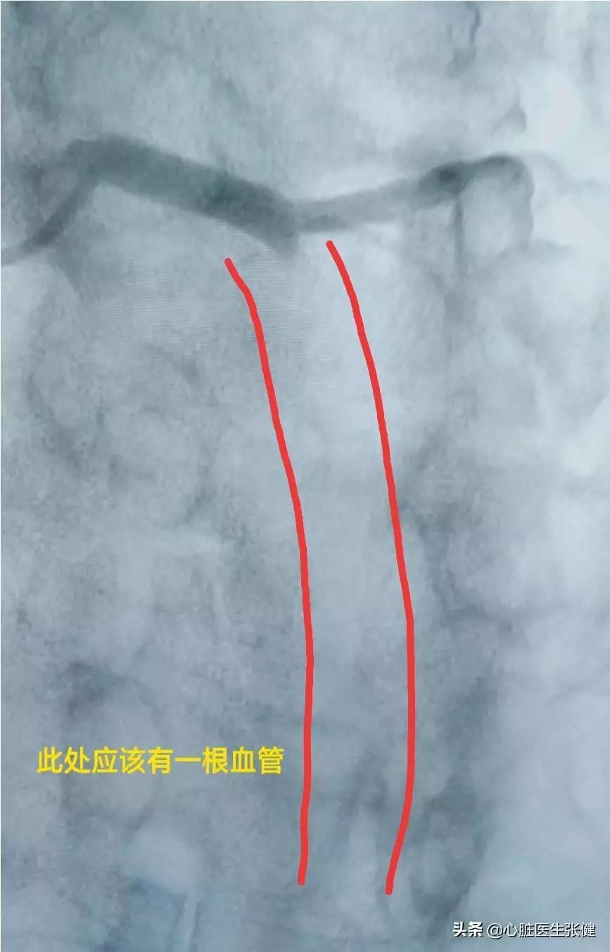 前降支在岔路口被血栓吃掉了