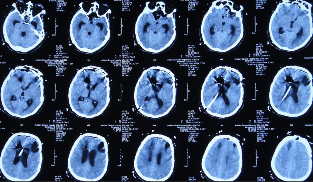 腦外傷後腦脊液鼻漏腦積水顱內感染歷時1年半成功治療經驗分享顱腦