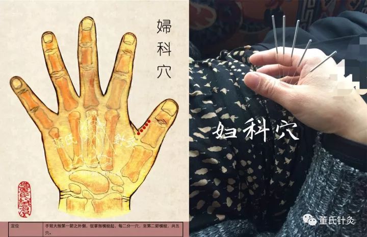 【穴位位置图】【门金,妇科,手解,三其】临床上单侧取穴,左右交替扎针