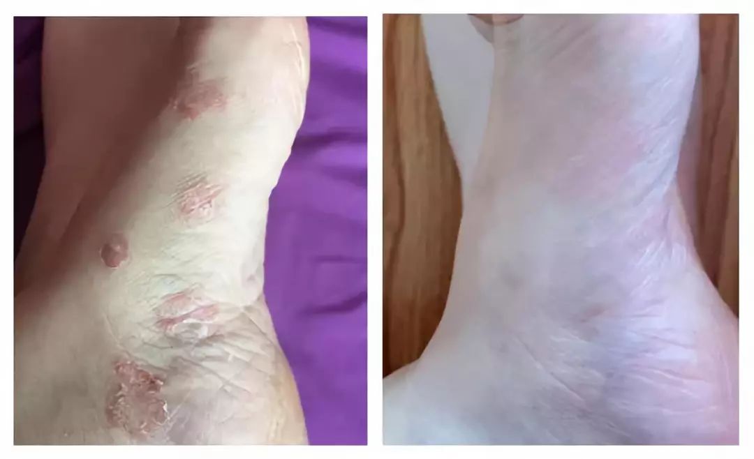 根治脚气很麻烦教你一招5分钟见效7天轻松搞定